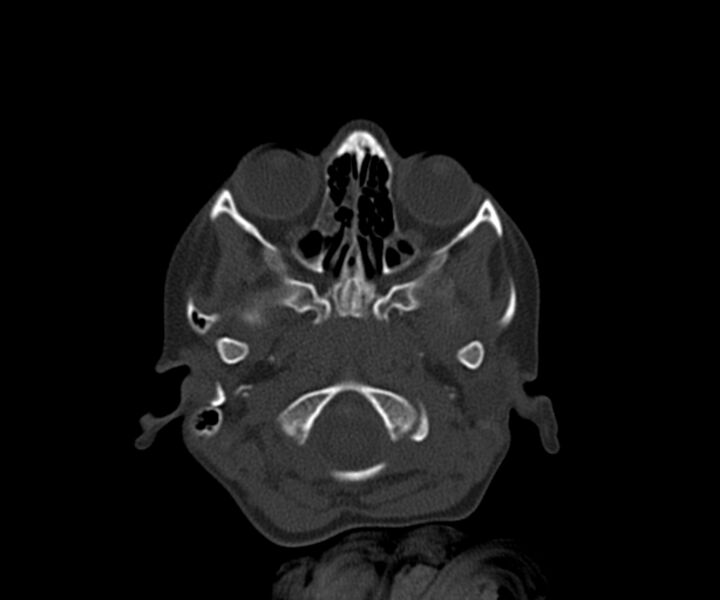 File:Acute epidural hematoma (Radiopaedia 63659-72335 Axial bone window 1).jpg