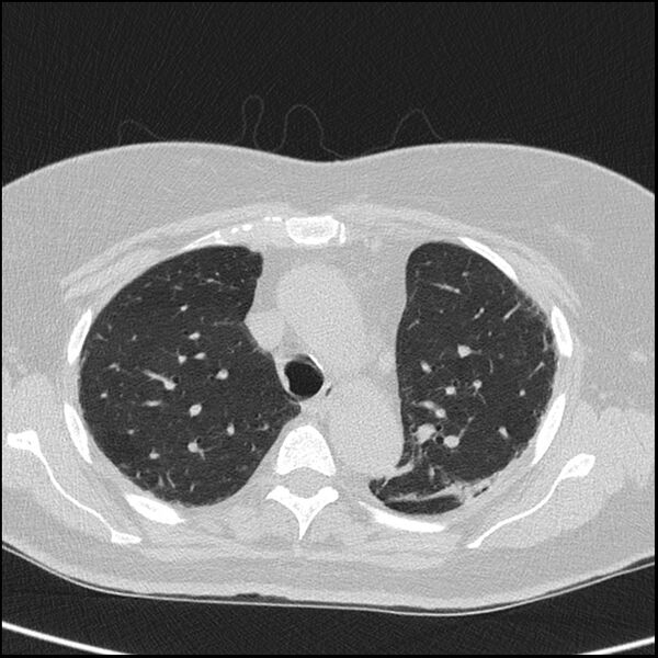 File:Acute interstitial pneumonitis (Radiopaedia 45404-49453 Axial lung window 27).jpg
