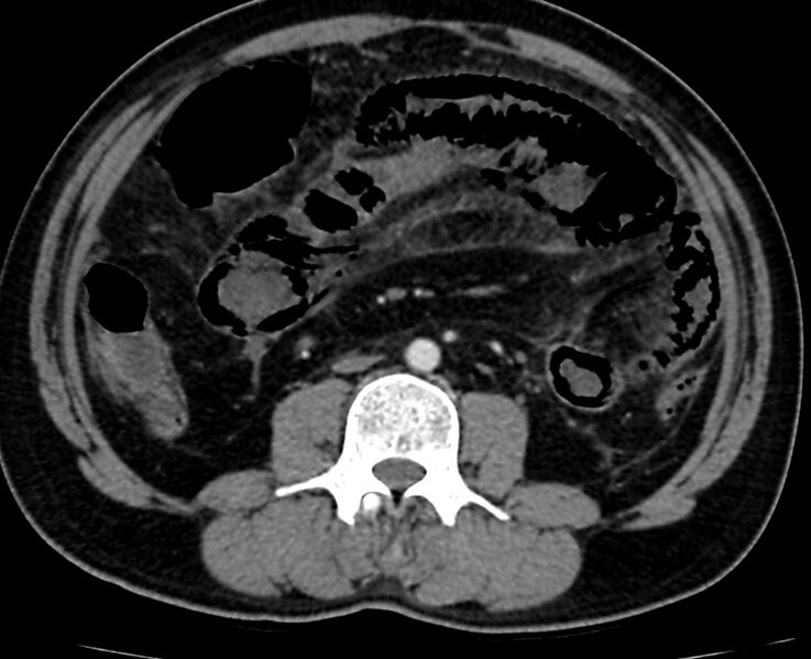 File:Acute mesenteric ischemia - superior mesenteric artery thrombosis (Radiopaedia 73947-84776 Axial C+ arterial phase 71).jpg
