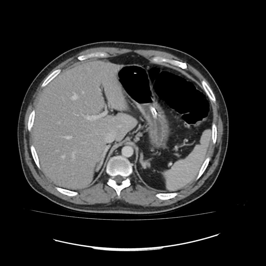 Acute mesenteric ischemia - superior mesenteric artery thrombosis (Radiopaedia 73947-84776 Axial C+ portal venous phase 5).jpg