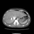 Acute myocarditis (Radiopaedia 55988-62613 Axial C+ portal venous phase 13).jpg