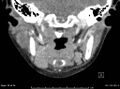 Acute parotitis (Radiopaedia 54123-60294 Coronal C+ arterial phase 9).jpg