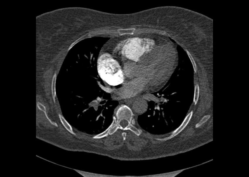 Acute pulmonary embolism (Radiopaedia 29938-30466 Axial C+ CTPA 116).jpg