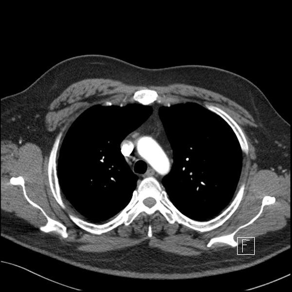 File:Acute pulmonary embolism with pulmonary infarct (Radiopaedia 73062-83768 Axial C+ CTPA 19).jpg