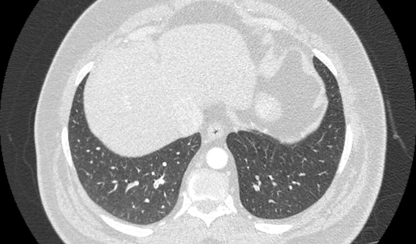 Acute pulmonary embolism with pulmonary infarcts (Radiopaedia 77688-89908 Axial lung window 105).jpg