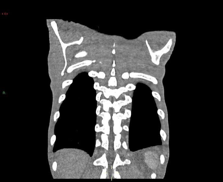 File:Acute right lung abscess (Radiopaedia 34806-36258 Coronal C+ arterial phase 4).jpg