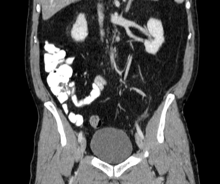 File:Acute sigmoid colon diverticulitis (Radiopaedia 55507-61976 Coronal C+ portal venous phase 79).jpg