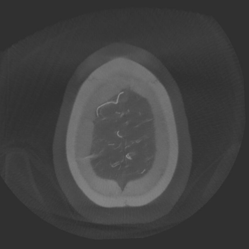 Acute subarachnoid hemorrhage and accessory anterior cerebral artery (Radiopaedia 69231-79010 Axial arterial - MIP 81).jpg