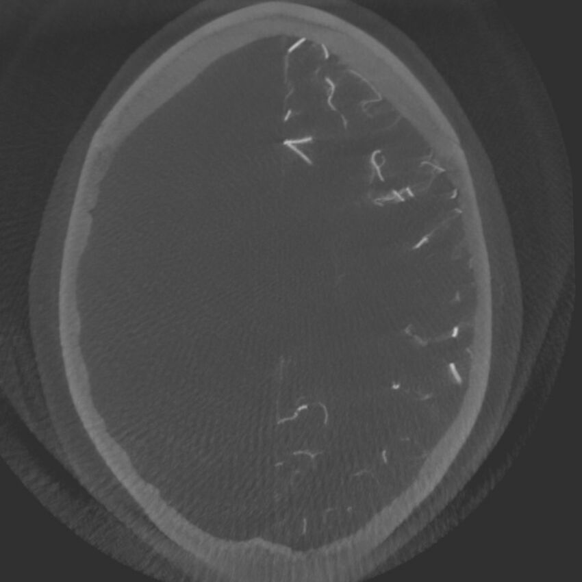Acute subarachnoid hemorrhage and accessory anterior cerebral artery (Radiopaedia 69231-79010 C 50).jpg