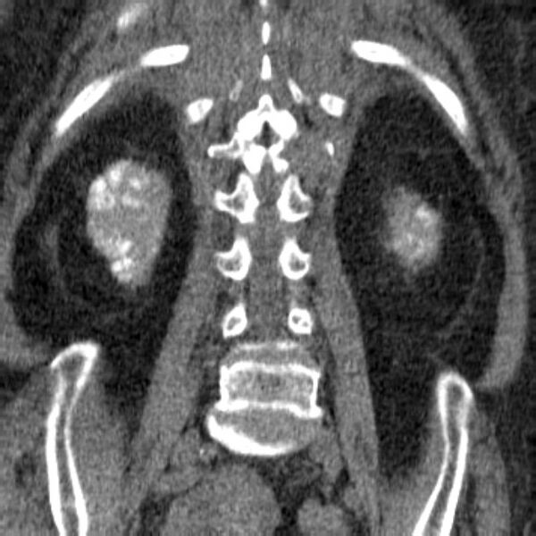 File:Acute tubular necrosis (Radiopaedia 28077-28334 Coronal non-contrast 28).jpg