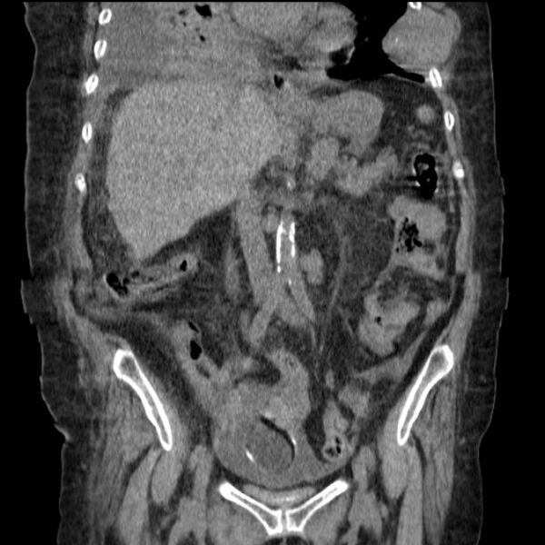 File:Acute tubular necrosis (Radiopaedia 28077-28334 D 44).jpg