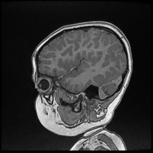 File:Adamantinomatous craniopharyngioma (Radiopaedia 77407-89529 Sagittal T1 C+ 30).jpg
