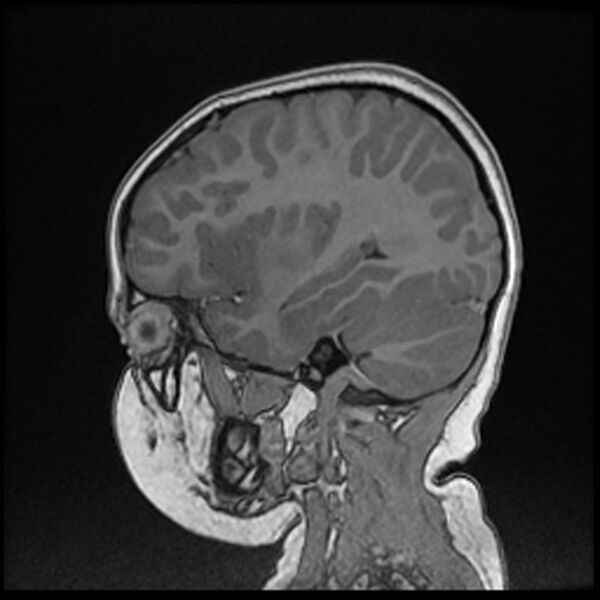 File:Adamantinomatous craniopharyngioma (Radiopaedia 77407-89529 Sagittal T1 C+ 96).jpg