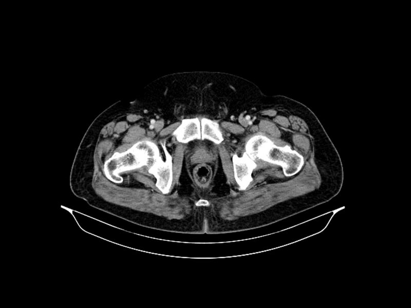 File:Adenocarcinoma of pancreas with hepatic metastasis (Radiopaedia 64332-73122 Axial C+ portal venous phase 100).jpg