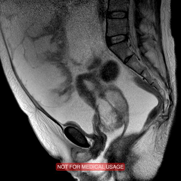 File:Adenocarcinoma of the cervix (Radiopaedia 28373-28615 Sagittal T2 8).jpg