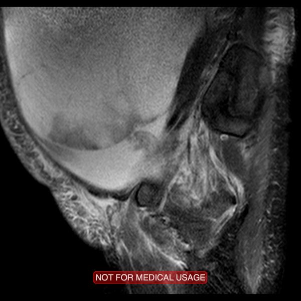 File:Adenocarcinoma of the cervix (Radiopaedia 28373-28615 Sagittal T2 fat sat 17).jpg