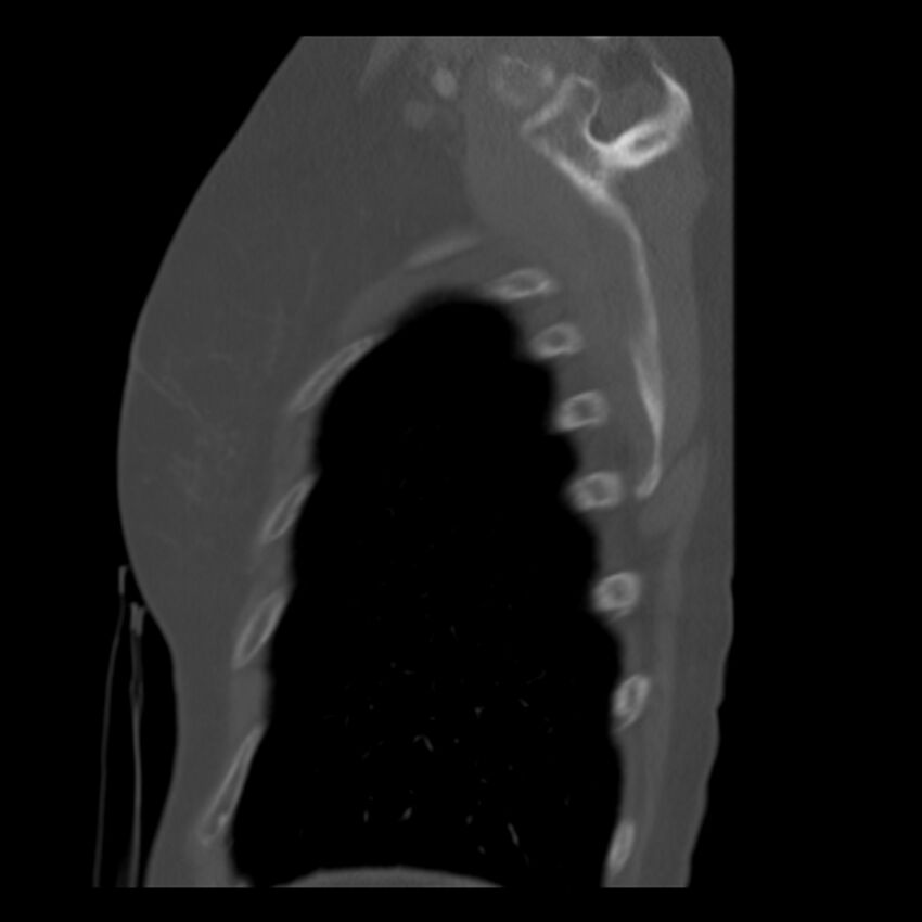 Adenocarcinoma of the lung (Radiopaedia 41015-43755 Sagittal bone window 100).jpg