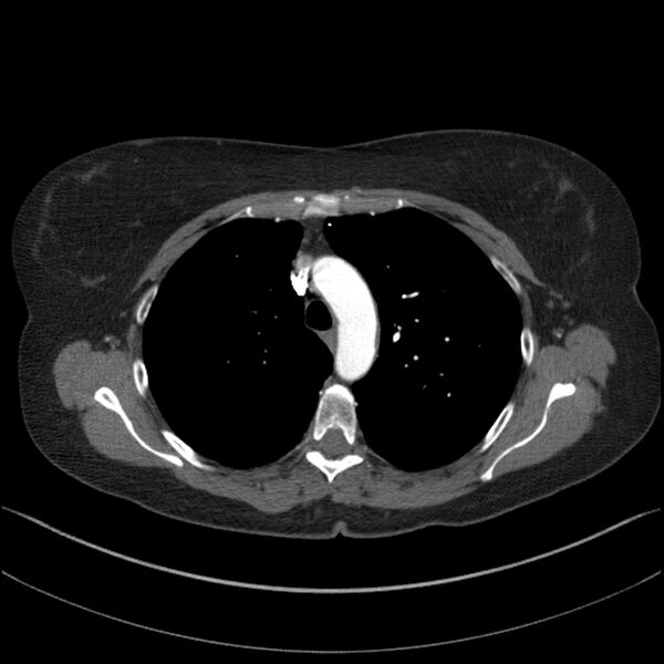 File:Adenocarcinoma of the lung (Radiopaedia 44205-47803 Axial C+ portal venous phase 26).jpg