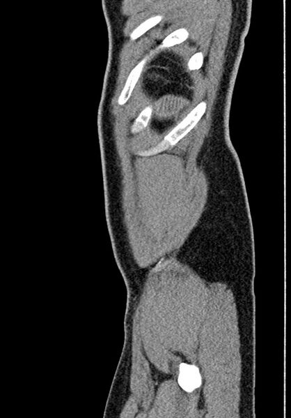 File:Adhesional small bowel obstruction (Radiopaedia 58900-66131 Sagittal C+ portal venous phase 236).jpg