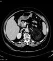 Adrenal myelolipoma (Radiopaedia 6765-7960 Axial C+ arterial phase 11).jpg