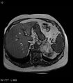 Adrenal myelolipoma (Radiopaedia 6765-7961 Axial T1 out-of-phase 12).jpg