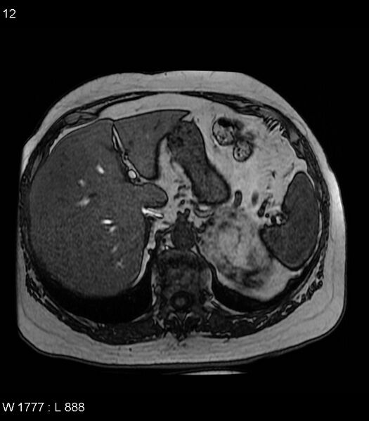 File:Adrenal myelolipoma (Radiopaedia 6765-7961 Axial T1 out-of-phase 12).jpg
