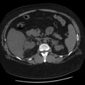Adrenal myelolipoma (Radiopaedia 8216-9068 Axial non-contrast 22).jpg