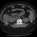 Adrenal myelolipoma (Radiopaedia 8216-9068 Axial non-contrast 27).jpg