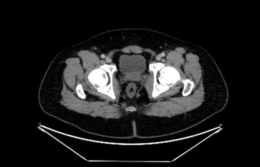 Adrenocortical carcinoma (Radiopaedia 80134-93438 Axial C+ portal venous phase 127).jpg