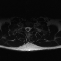 Aggressive vertebral hemangioma (Radiopaedia 39937-42404 Axial T2 39).png
