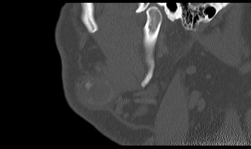 File:Ameloblastoma (Radiopaedia 33677-34806 Sagittal bone window 15).png