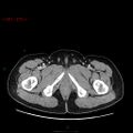 Ampullary carcinoma (Radiopaedia 56396-63056 C 109).jpg