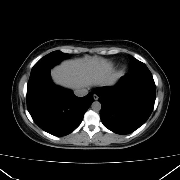 File:Ampullary tumor (Radiopaedia 22787-22816 Axial non-contrast 4).jpg