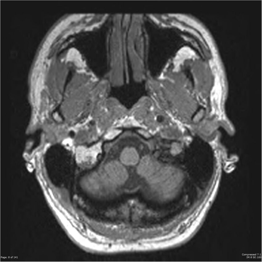 Anaplastic meningioma with recurrence (Radiopaedia 34452-35788 Axial T1 6).jpg