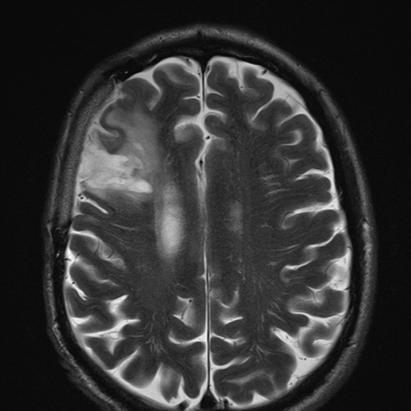File:Anaplastic meningioma with recurrence (Radiopaedia 34452-35788 Axial T2 19).png