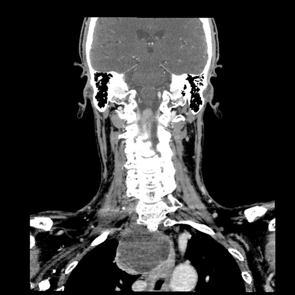 File:Anaplastic thyroid carcinoma (Radiopaedia 79087-92034 A 77).jpg