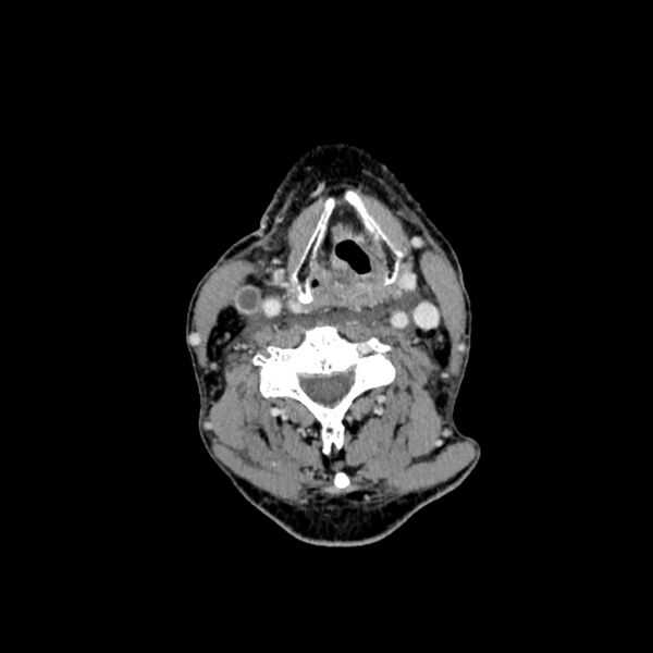 File:Anaplastic thyroid carcinoma (Radiopaedia 79087-92034 B 63).jpg