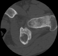 Aneurysmal bone cyst of ischium (Radiopaedia 25957-26094 B 23).png