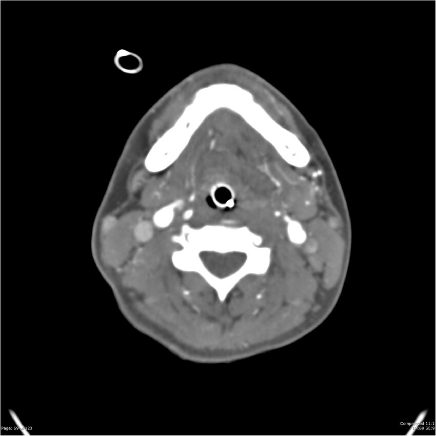 Aneurysmal subarachnoid hemorrhage and Moya Moya disease (Radiopaedia 34306-35593 Axial CT COW 69).jpg