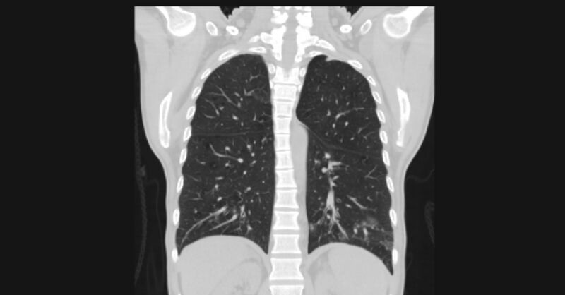 File:Angioinvasive aspergellosis (Radiopaedia 66995-76315 Coronal lung window 44).jpg