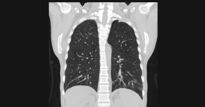 Angioinvasive aspergellosis (Radiopaedia 66995-76315 Coronal lung window 44).jpg