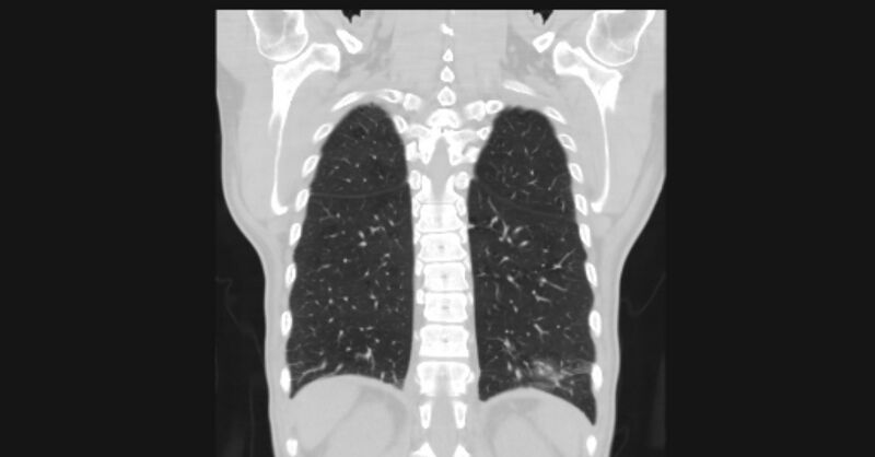 File:Angioinvasive aspergellosis (Radiopaedia 66995-76315 Coronal lung window 50).jpg