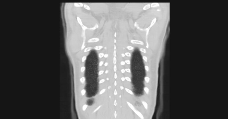 File:Angioinvasive aspergellosis (Radiopaedia 66995-76315 Coronal lung window 58).jpg