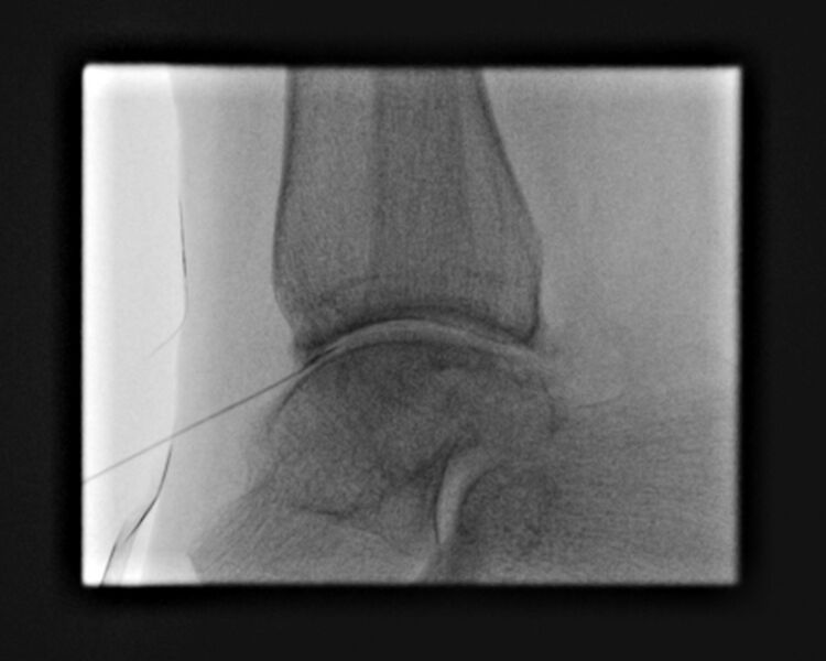 File:Ankle joint injection (fluoroscopic guided) (Radiopaedia 87288-103578 Lateral 3).jpg