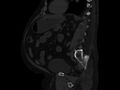 Ankylosing spondylitis (Radiopaedia 44609-48357 Sagittal bone window 67).jpg