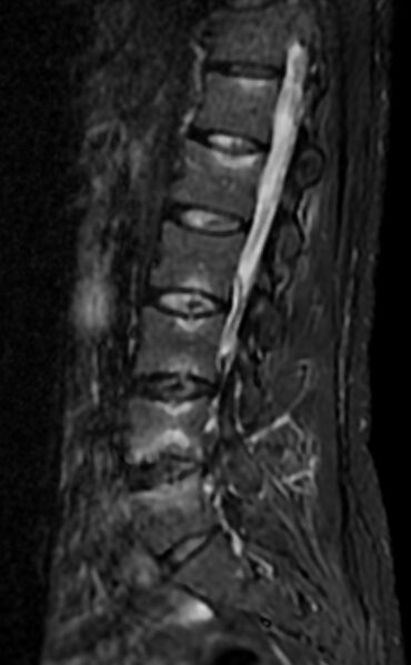 File:Ankylosing spondylitis - Andersson lesion (Radiopaedia 81878-95838 Sagittal STIR 5).jpg