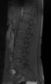 Ankylosing spondylitis - Andersson lesion (Radiopaedia 81878-95838 Sagittal T1 fat sat 4).jpg