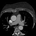 Anomalous origin of left circumflex artery from right coronary sinus (Radiopaedia 72563-83117 B 5).jpg