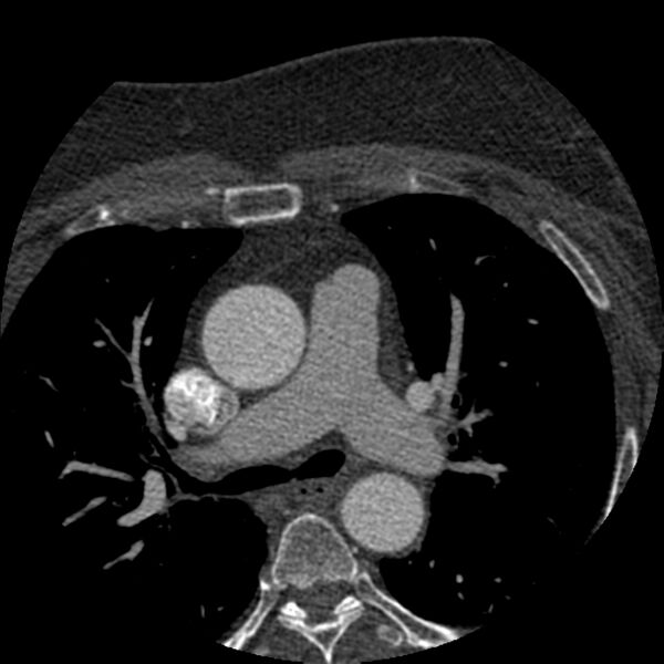 File:Anomalous origin of left circumflex artery from right coronary sinus (Radiopaedia 72563-83117 B 5).jpg