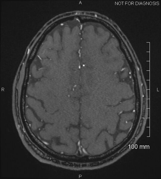 File:Anterior cerebral artery aneurysm (Radiopaedia 80683-94127 Axial MRA 194).jpg